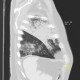 Bronchopneumonia, biopsy: CT - Computed tomography