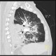 Bronchopneumonia, biopsy, recurrence: CT - Computed tomography