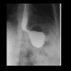 Gastric banding: RF - Fluoroscopy