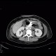 Barium, beam hardening artifacts: CT - Computed tomography