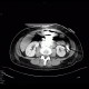 Barium, beam hardening artifacts: CT - Computed tomography