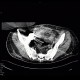 Barium, beam hardening artifacts: CT - Computed tomography