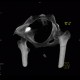 Barium, beam hardening artifacts: CT - Computed tomography