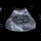 Angiomyolipoma, renal, bilateral: US - Ultrasound