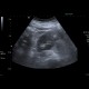 Angiomyolipoma, renal, bilateral: US - Ultrasound