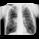 Lung carcinoma, biopsy: X-ray - Plain radiograph