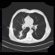 Lung carcinoma, biopsy: CT - Computed tomography