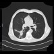 Lung carcinoma, biopsy: CT - Computed tomography