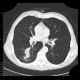 Lung carcinoma, biopsy: CT - Computed tomography
