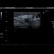 Biopsy of breast: US - Ultrasound
