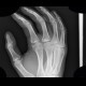 Bone island, metacarpal bone: X-ray - Plain radiograph