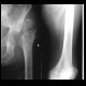 Bone sequestration, osteomyelitis: X-ray - Plain radiograph