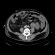 Bowel ischemia, vascular ileus: CT - Computed tomography