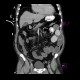 Bowel ischemia, vascular ileus: CT - Computed tomography