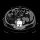 Bowel ischemia, vascular ileus: CT - Computed tomography