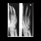 Boxer's fracture: X-ray - Plain radiograph