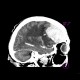 Brain tumour, meningioma: CT - Computed tomography