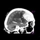 _fetch_thumbnail.php?img=Brain%20tumour.CT.1_0001.JPG