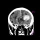 Brain tumour, meningioma: CT - Computed tomography