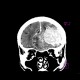Brain tumour, meningioma: CT - Computed tomography
