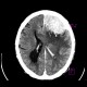 Brain tumour, meningioma: CT - Computed tomography