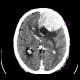 Brain tumour, meningioma: CT - Computed tomography