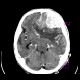 Brain tumour, meningioma: CT - Computed tomography