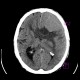 Brain tumour, meningioma: CT - Computed tomography