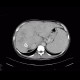 Budd-Chiari syndrome, thrombosis of hepatic veins, liver cirrhosis, TIPSS, splenomegally: CT - Computed tomography