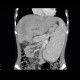 Budd-Chiari syndrome, thrombosis of hepatic veins, liver cirrhosis, TIPSS, splenomegally: CT - Computed tomography