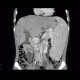 Budd-Chiari syndrome, thrombosis of hepatic veins, liver cirrhosis, TIPSS, splenomegally: CT - Computed tomography