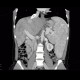Budd-Chiari syndrome, thrombosis of hepatic veins, liver cirrhosis, TIPSS, splenomegally: CT - Computed tomography