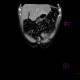 Burkitt's lymphoma of small bowel and liver: CT - Computed tomography