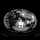 Burkitt's lymphoma of small bowel and liver: CT - Computed tomography