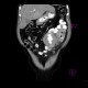 Burkitt's lymphoma of small bowel and liver: CT - Computed tomography