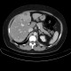 Carcinoma of sigmoid colon, metastasis of liver: CT - Computed tomography