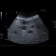 Carcinoma of sigmoid colon, metastasis of liver: US - Ultrasound