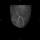 Caput medusae, liver cirrhosis, alcoholic liver cirrhosis, portal hypertension, splenomegally: CT - Computed tomography