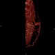 Caput medusae, liver cirrhosis, alcoholic liver cirrhosis, portal hypertension, splenomegally: CT - Computed tomography