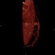 Caput medusae, liver cirrhosis, alcoholic liver cirrhosis, portal hypertension, splenomegally: CT - Computed tomography