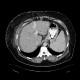 Caput medusae, liver cirrhosis, alcoholic liver cirrhosis, portal hypertension, splenomegally: CT - Computed tomography