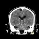 Cavum septi pellucidi, cavum vergae: CT - Computed tomography