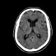 Cavum septi pellucidi, cavum vergae: CT - Computed tomography