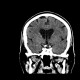Cavum septi pellucidi, cavum vergae: CT - Computed tomography