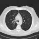 Centrilobular emphysema: CT - Computed tomography