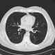 Centrilobular emphysema, HRCT: CT - Computed tomography