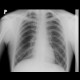 Cervical rib: X-ray - Plain radiograph