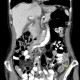 Acute cholecystitis: CT - Computed tomography