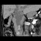 Choledocholithiasis, bile duct stones: CT - Computed tomography