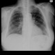 Chondrohamartoma of lung, ground-glass: X-ray - Plain radiograph